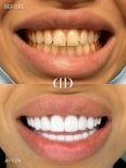 Before and after veneers at Darya Dental Turkey, smile transformation with whiter teeth result