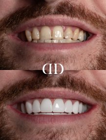 Before and after veneers at Darya Dental Turkey – smile makeover with natural-looking results