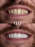 Before and after veneers at Darya Dental Turkey – smile makeover with natural-looking results