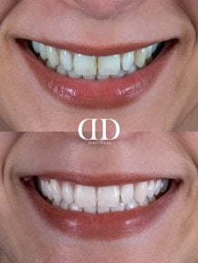 Результати до і після відбілювання зубів у Darya Dental Turkey, помітно біліша усмішка
