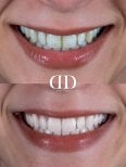 Результати до і після відбілювання зубів у Darya Dental Turkey, помітно біліша усмішка
