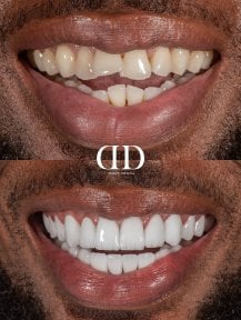 До та після встановлення зубних коронок у Darya Dental Turkey, результат зміни посмішки