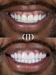 Before and after dental crown installation at Darya Dental Turkey, improved smile result