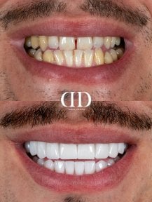 До і після встановлення коронок у Darya Dental Turkey – покращена посмішка та білі зуби