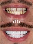 До і після встановлення коронок у Darya Dental Turkey – покращена посмішка та білі зуби