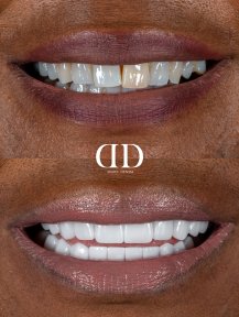 Before and after dental crown installation results at Darya Dental Turkey, improved smile aesthetics