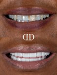 Before and after dental crown installation results at Darya Dental Turkey, improved smile aesthetics