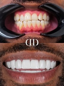 Результати до і після встановлення коронок у Darya Dental Turkey, покращення посмішки