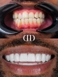 Результати до і після встановлення коронок у Darya Dental Turkey, покращення посмішки