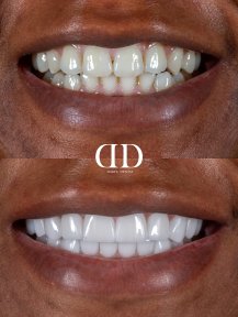Before and after dental crown installation results at Darya Dental Turkey, improved smile aesthetics