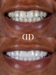 Before and after dental crown installation results at Darya Dental Turkey, improved smile aesthetics