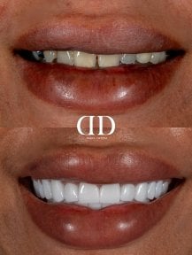 Результати до і після встановлення коронок у Darya Dental Turkey, трансформація усмішки