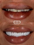 Результати до і після встановлення коронок у Darya Dental Turkey, трансформація усмішки