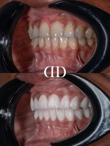 Before and after dental crown installation at Darya Dental Turkey, improved smile result