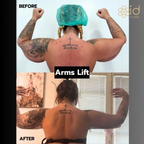 before-after photo tummy-tuck-and-liposuction