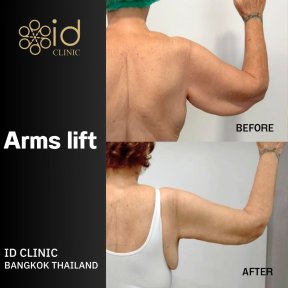 before-after photo tummy-tuck-and-liposuction