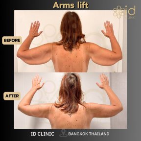 before-after photo tummy-tuck-and-liposuction