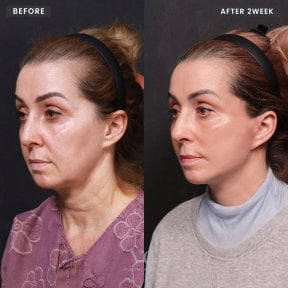 before-after photo deep-plane-facelift