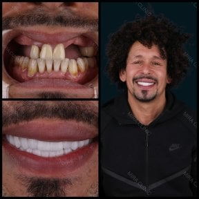 Before and after full dentures installation at Mira Clinic, smile restoration result