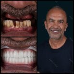 Before and after full dentures installation at Mira Clinic, restored smile and dental function result