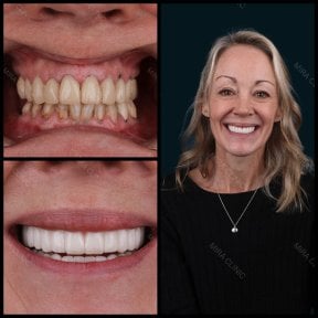 Before and after full dentures installation at Mira Clinic, visible smile transformation result