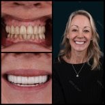 Before and after full dentures installation at Mira Clinic, visible smile transformation result