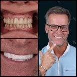 Full dentures before and after results at Mira Clinic, visible smile transformation