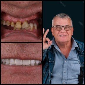 before-after photo dental-bridge-installation