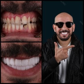 before-after photo dental-bridge-installation