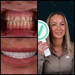 before-after photo dental-bridge-installation