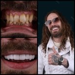 Before and after zirconia crown results at Mira Clinic, improved smile and dental aesthetics