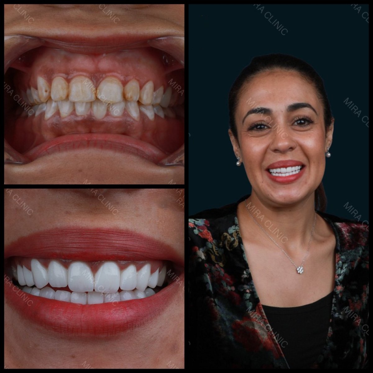 Resultados antes y después de coronas de zirconio en Mira Clinic, transformación de la sonrisa