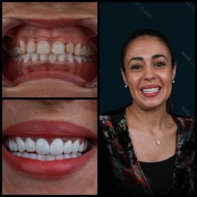 Before and after zirconia crown results at Mira Clinic, smile makeover with natural teeth