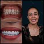 Before and after zirconia crown results at Mira Clinic, smile makeover with natural teeth