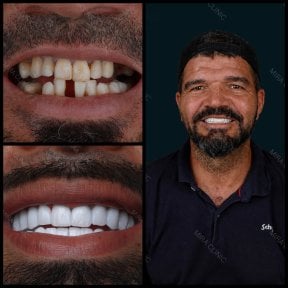 Before and after zirconia crown results at Mira Clinic, smile makeover with natural teeth