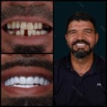 Before and after zirconia crown results at Mira Clinic, smile makeover with natural teeth