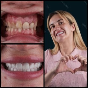 Before and after zirconia crown results at Mira Clinic, smile makeover with natural teeth
