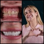 Before and after zirconia crown results at Mira Clinic, smile makeover with natural teeth