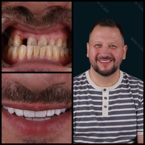before-after photo dental-crown-installation