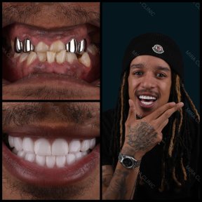 before-after photo dental-crown-installation
