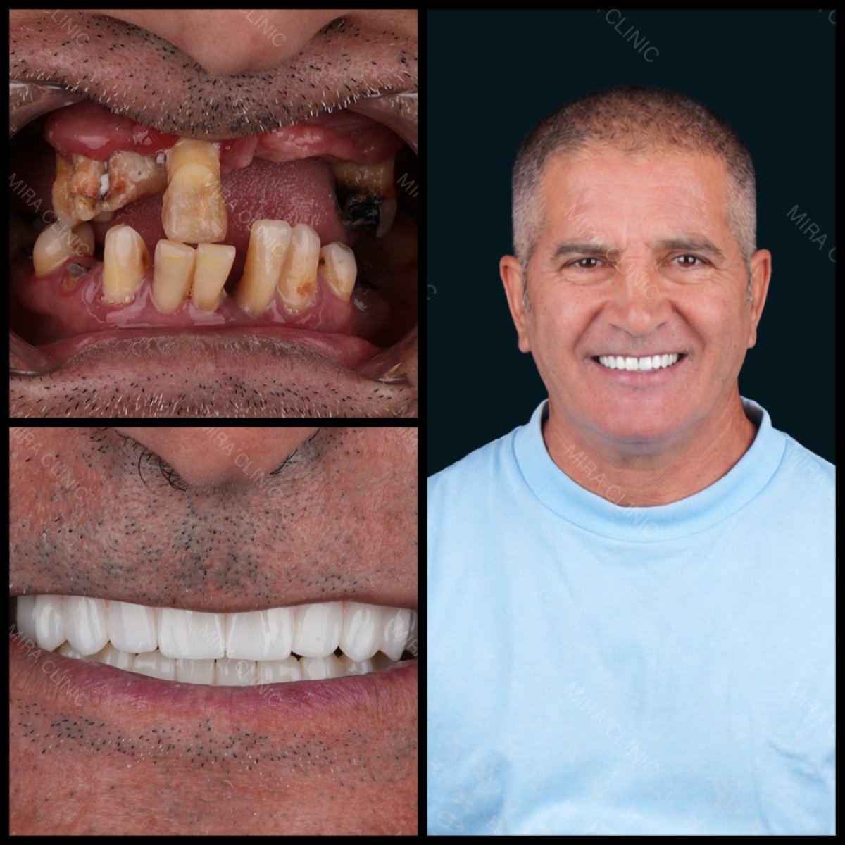 Resultados antes y después de coronas dentales en Mira Clinic, sonrisa restaurada