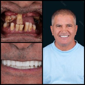 before-after photo dental-crown-installation