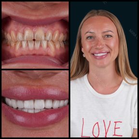 before-after photo dental-crown-installation