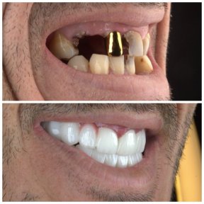 before-after photo dental-crown-installation