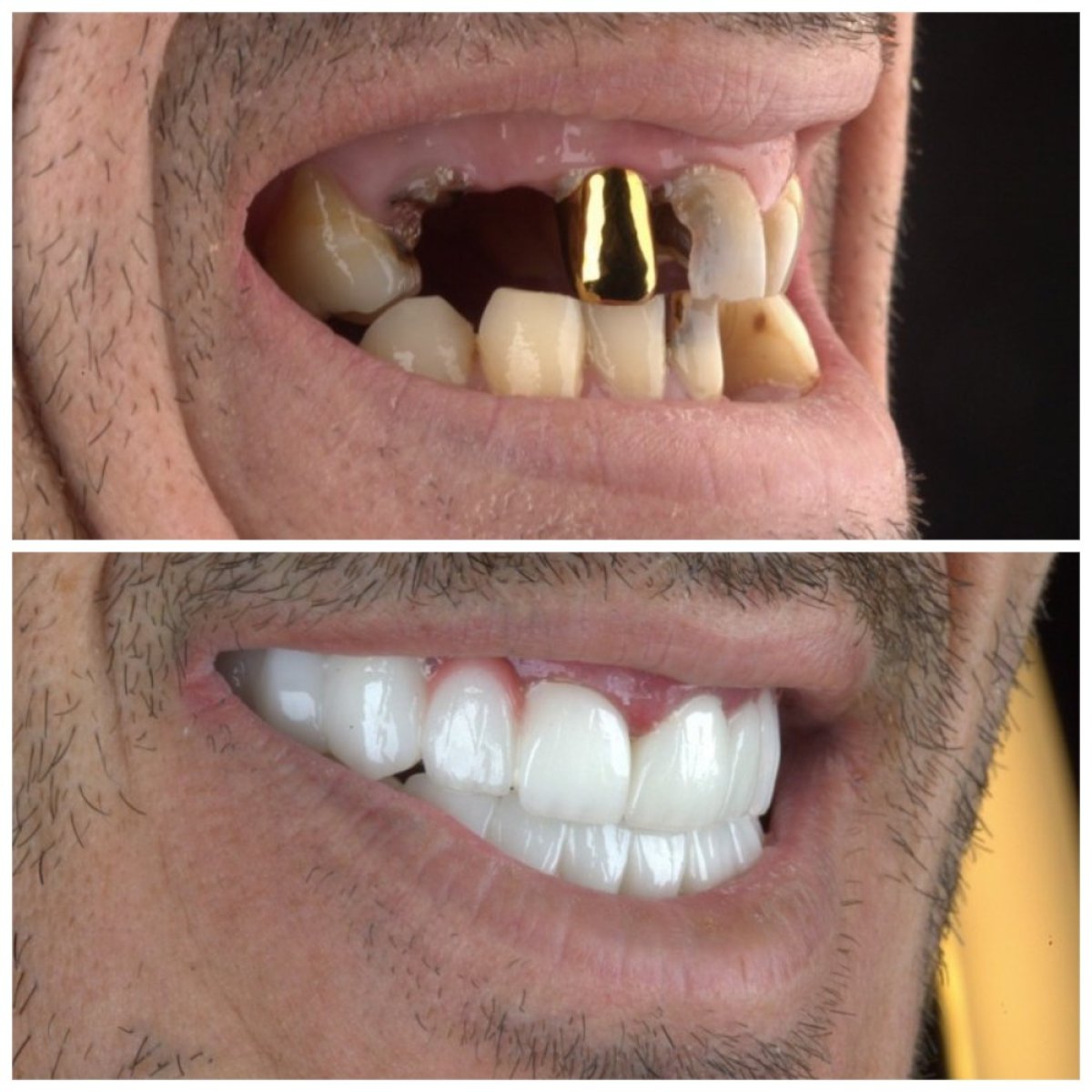 نتائج قبل وبعد زراعة الأسنان في SUAVE DENTAL CLINIC، ابتسامة مستعادة