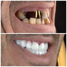 Before and after dental implant results at SUAVE DENTAL CLINIC, restored smile transformation