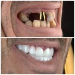 Before and after dental implant results at SUAVE DENTAL CLINIC, restored smile transformation