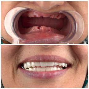 before-after photo dental-crown-installation