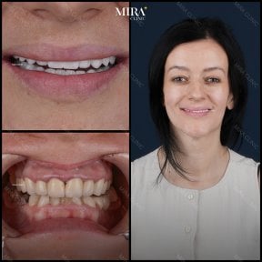 Bone graft dental procedure result at Mira Clinic (Mira Clinic SAĞLIK TURİZM ŞİRKETİ), improved smile