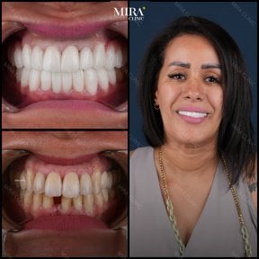 Before and after dental veneers results at Mira Clinic, smile transformation and whiter teeth